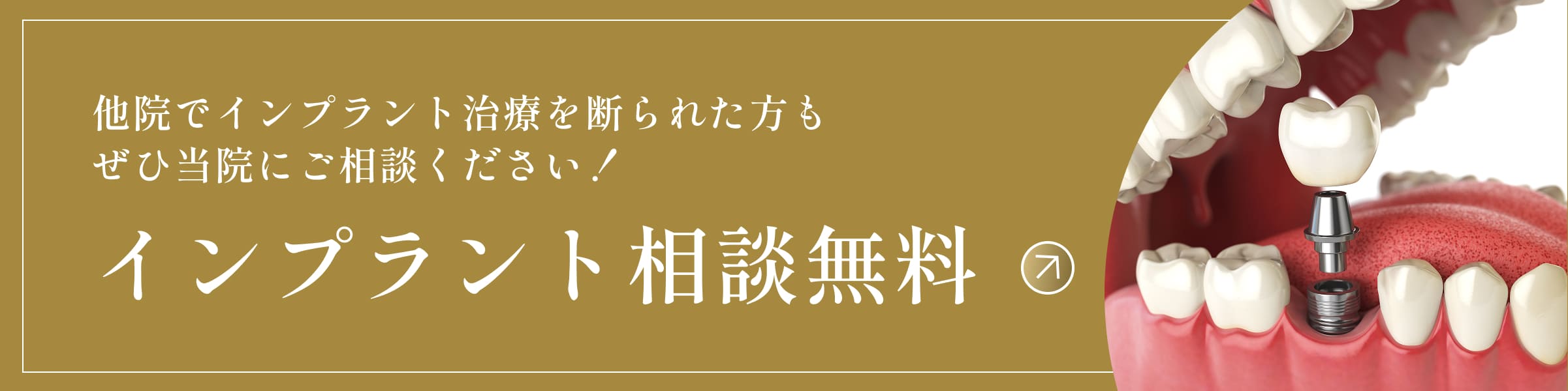他院でインプラント治療を断られた方もぜひ当院にご相談ください！インプラント相談無料