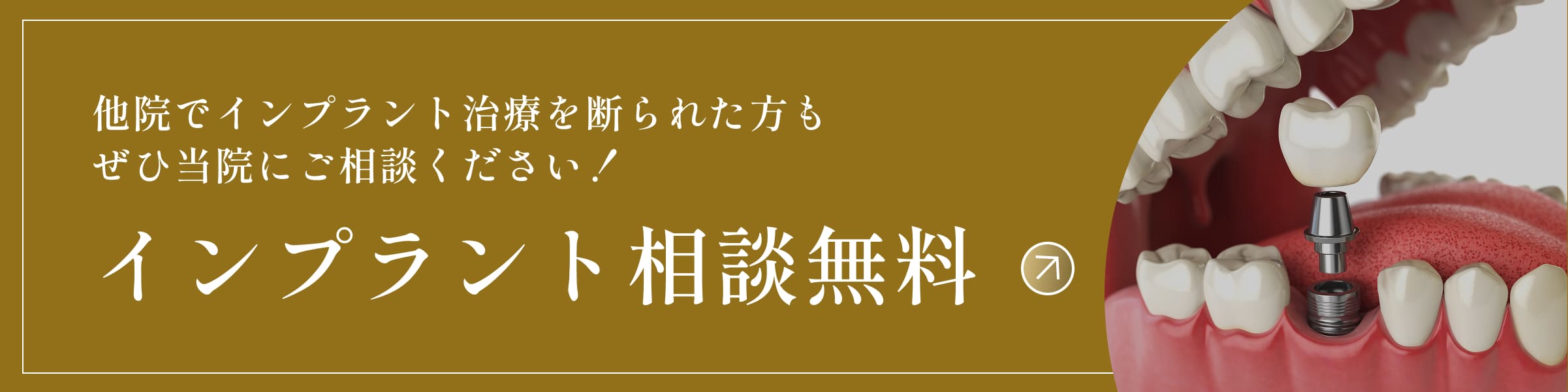 他院でインプラント治療を断られた方もぜひ当院にご相談ください！インプラント相談無料