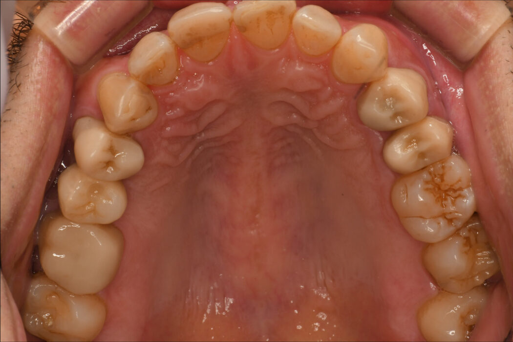 噛めるようになりたい