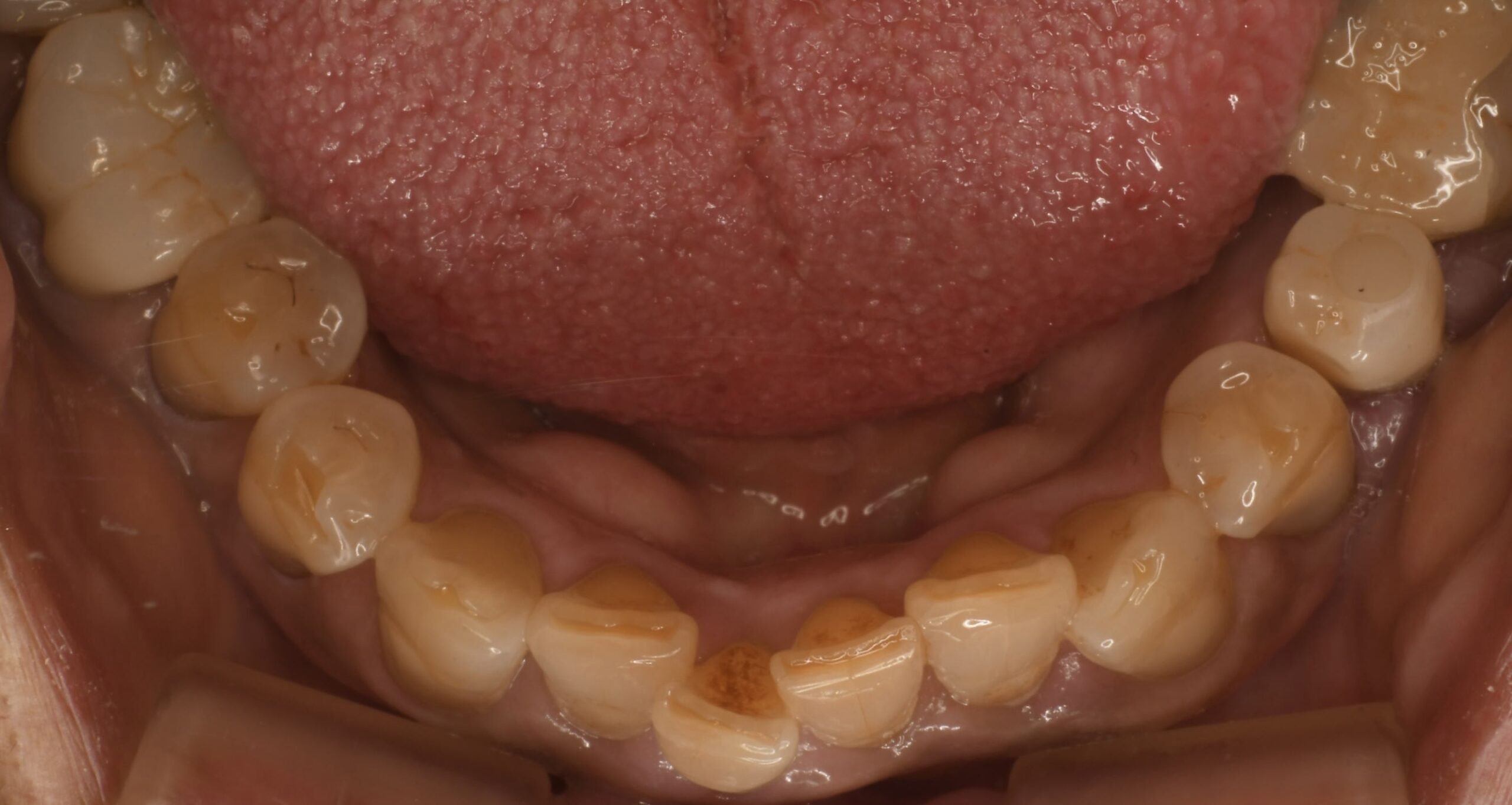 上下にあるむし歯が大きく、かつ膿んでいる